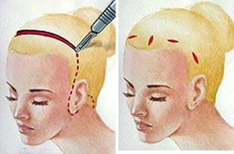 lifting-endoscopico-ejemplo