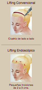 lifting-endoscopico-tradicional